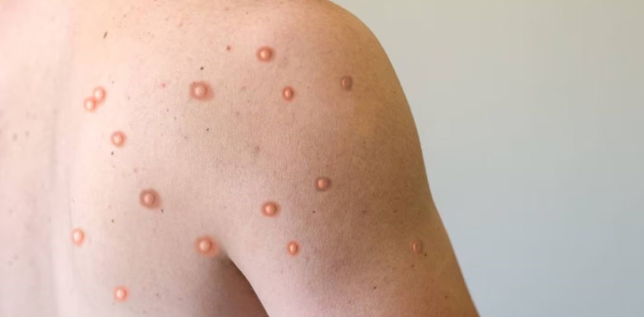 Registran en Argentina el primer caso de la cepa más agresiva y contagiosa de la “viruela del mono”

